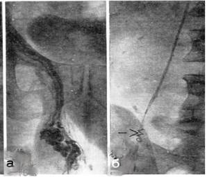 Варикоцеле: фото до и после операции