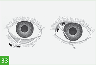 Схема забора материала на ПЦР  со слизистой глаз