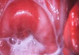 Бактериальный вагиноз: фото