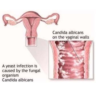 Симптомы кандидоза у женщин