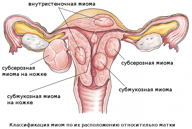 Классификация миомы матки по месту локализации