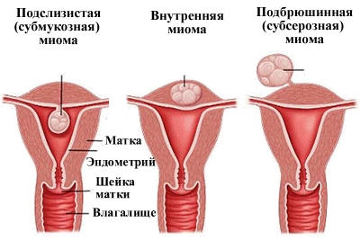 Классификация миомы матки по составу узлов
