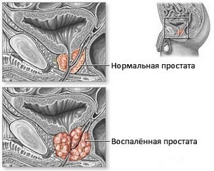 Симптомы абактериального простатита