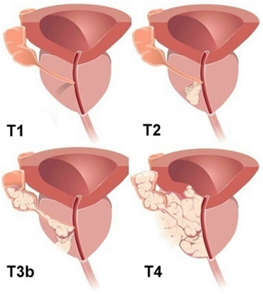 Классификация рака предстательной железы по системе TNM