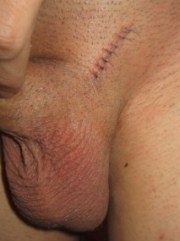 варикоцеле шрам после операции фото