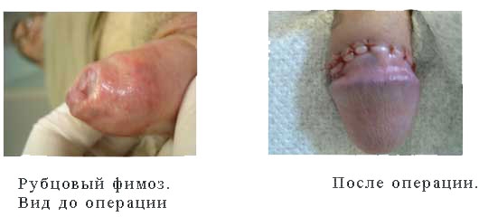 Фимоз у мужчин: фото до и после операции