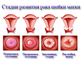Заболевания шейки матки: виды и классификация