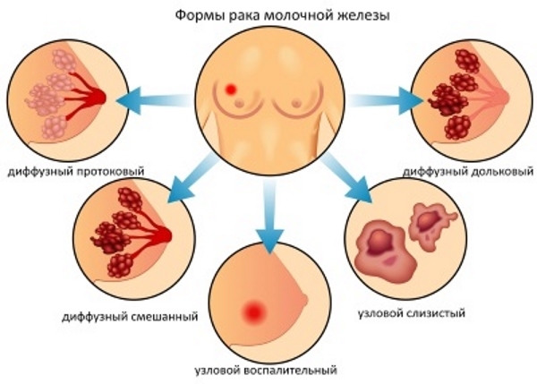 Рак молочной железы виды