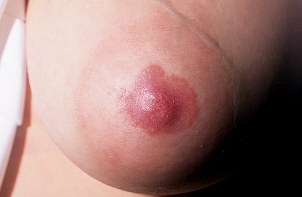 Рак молочной железы: фото