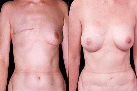 Пластика после удаления груди (фото до и после)