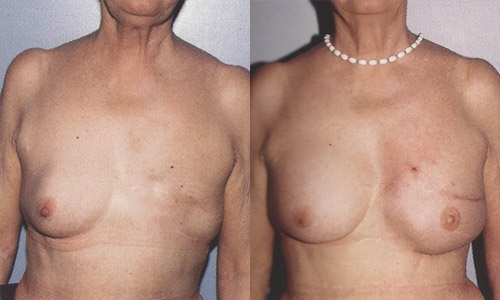 Пластика после удаления груди (фото до и после)