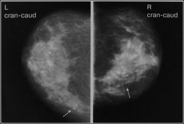  фото маммограммы с образованием микрокальцинатов различной формы
