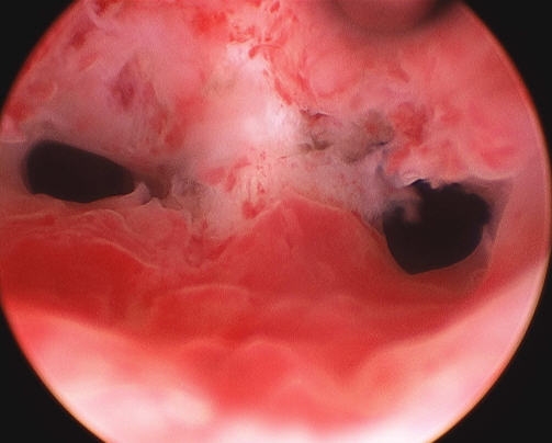  гистероскопия при перегородке в полости матки