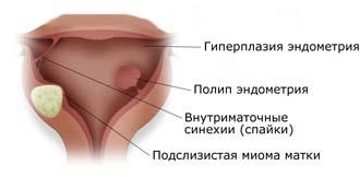 В каких случаях показана гистероскопия матки?