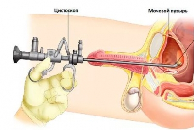 Папиллома мочевого пузыря у мужчин лечение thumbnail