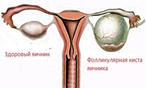 Какие бывают кисты яичников у женщин фото