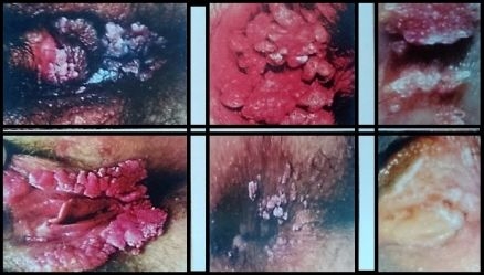 Разновидности папилломатозной инфекции на гениталиях, экзофитный рост