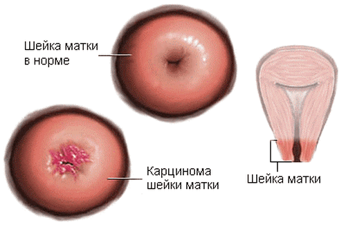 Инфекционная папиллома на шейке матки