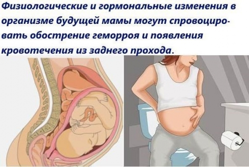Послеродовой геморрой при беременности