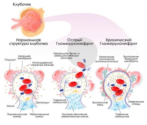 Хронический гломерулонефрит с мочевым и гипертоническим синдромом
