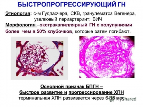 Хронический гломерулонефрит с изолированным мочевым синдромом армия