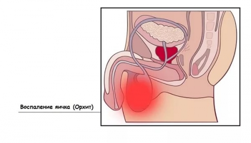 Как вылечить воспаление в сперме