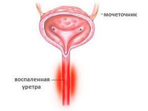 Как вылечить воспаление в сперме
